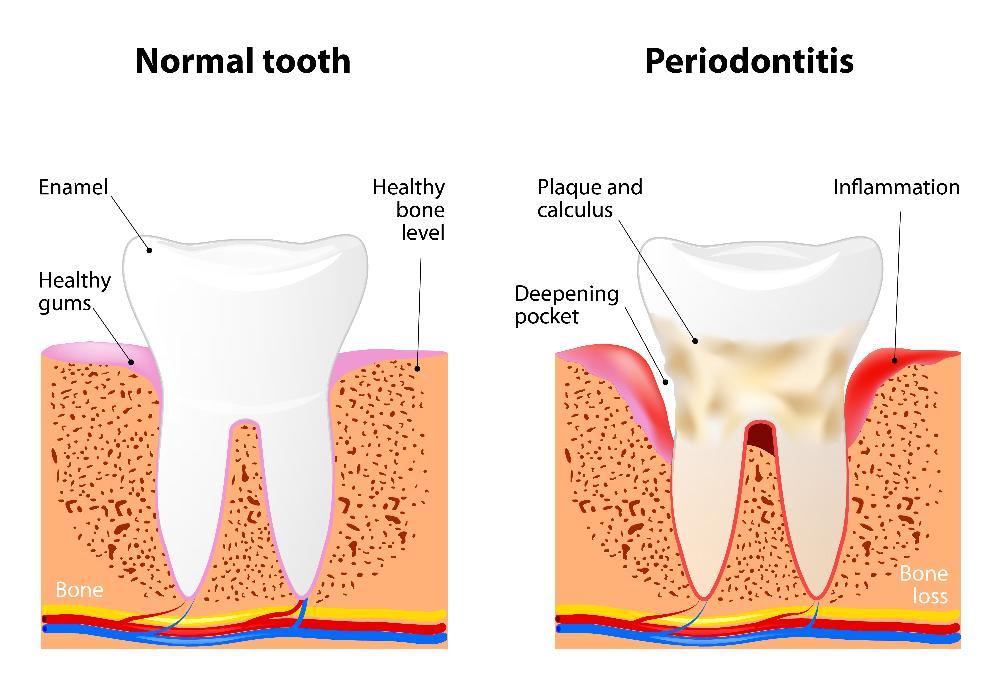 Diagram of periodontal disease in lincoln ne