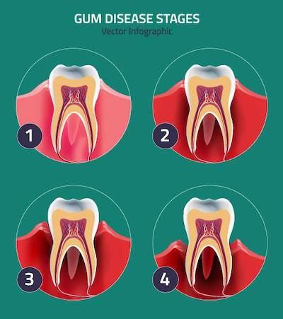 gum disease stages