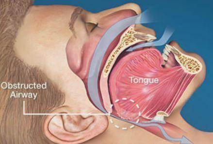 diagram of person who suffers from sleep apnea