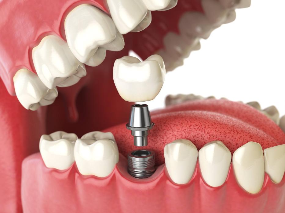 implant going into jaw