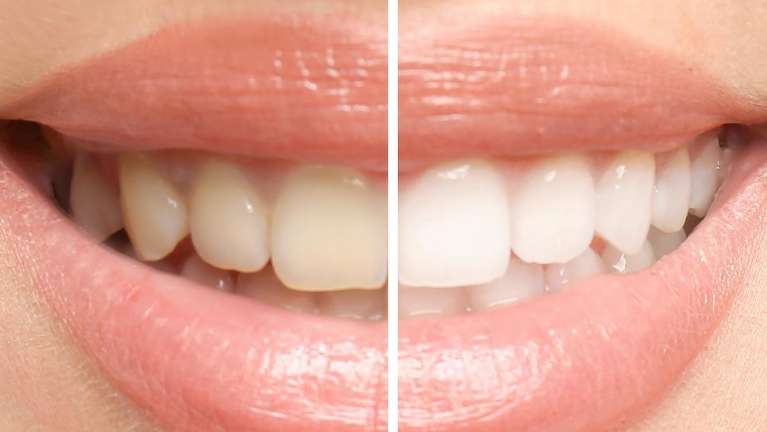 smile before and after teeth whitening