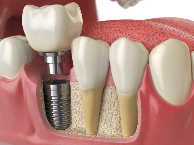parts of a dental implant going into jawbone