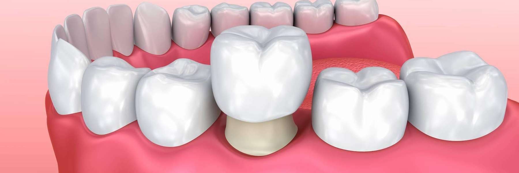 dental crown