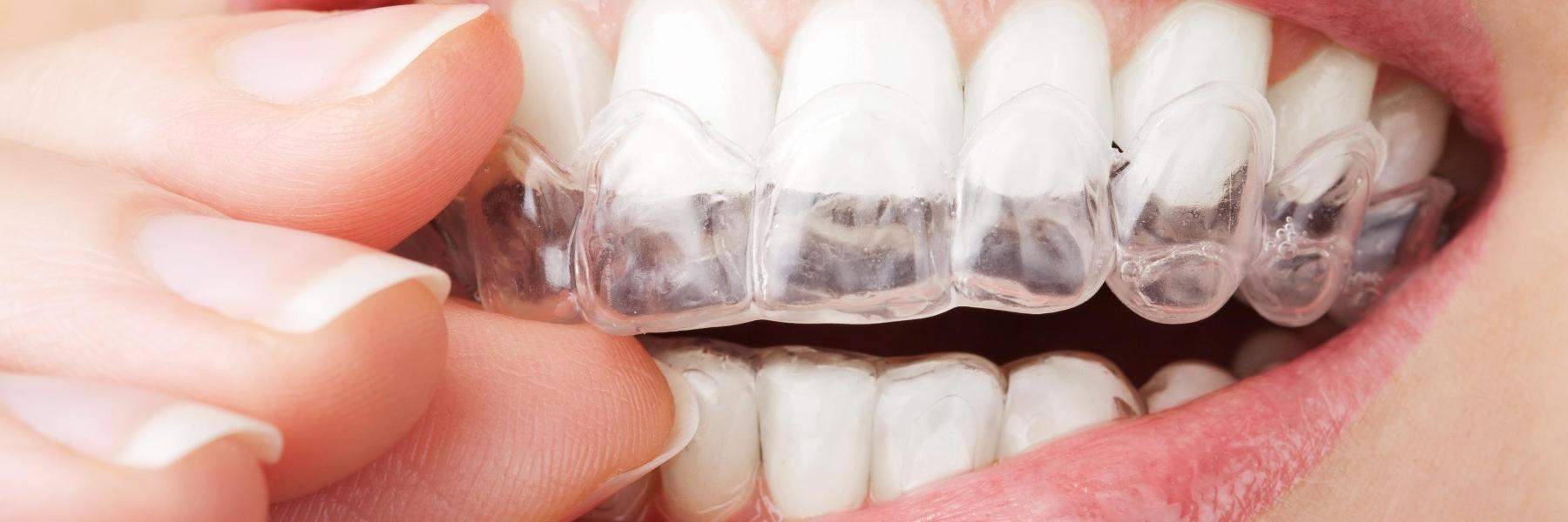 woman putting in invisalign in lincoln 