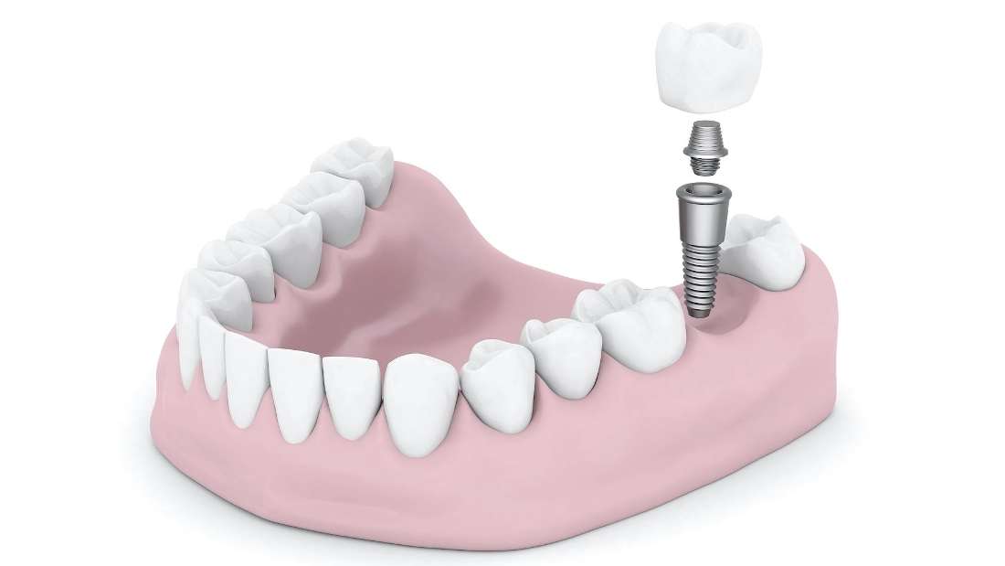 What to Know Dental Implants Dental Implants Lincoln NE
