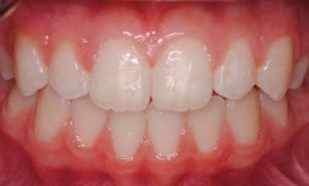 Clear-Aligners-After-Image