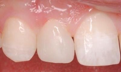 Patient's tooth after dental bonding procedure in Lincoln, NE