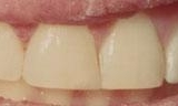 chipped tooth after dental bonding