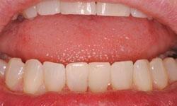 dental bonding fills in small gaps between teeth