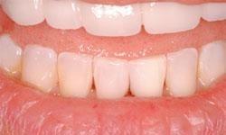dental bonding used to close gap between bottom teeth