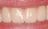 Close up of teeth after dental bridge placement in Lincoln, NE