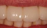 Close up of front teeth after dental bridge in Lincoln, NE