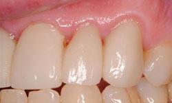 Dental-Crowns-Used-to-Fix-Cracked-Tooth-After-Image