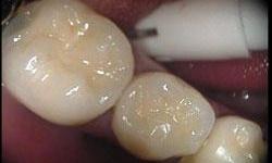 Close up of molars after dental filling replacement in Lincoln