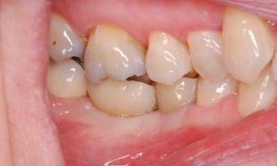 Patient's tooth after dental implant in Lincoln, NE