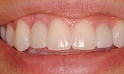 Dental-Implants-After-Image