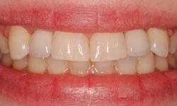 Patient's teeth after dental implants in Lincoln, NE 68506