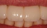 front teeth lengthened from smile makeover