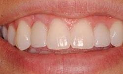 Patient's teeth after smile makeover in Lincoln, NE