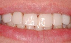 gap in front teeth closed with smile makeover