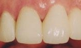 Patients teeth after cosmetic dentistry in Lincoln, NE 68505