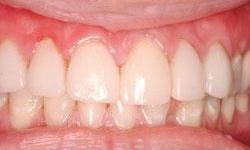 Close up of teeth after veneers in Lincoln, NE