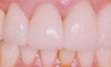After dental veneers