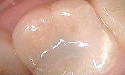 White-Dental-Fillings-Used-to-Replace-Old-Metal-Fillings-After-Image