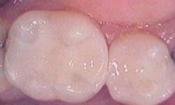 White-Dental-Fillings-After-Image