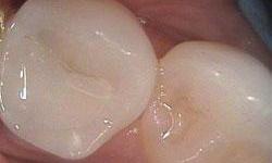 Close up of molar after tooth-colored filling procedure at Lincoln, NE dentist
