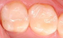 twon new white dental fillings in Lincoln