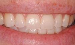 Professional-Teeth-Whitening-After-Image