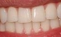 In-Office-Professional-Whitening-After-Image
