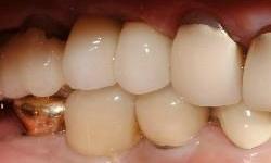 Dental-Implants-After-Image
