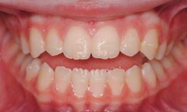 Clear-Aligners-Before-Image