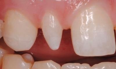 Close up of tooth before dental bonding in Lincoln, NE