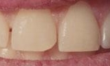 chipped tooth before dental bonding