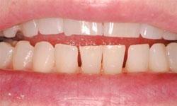 bottom teeth with small gaps between teeth