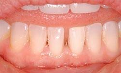 gap between bottom teeth