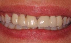 Close up of teeth before dental bridge in Lincoln Nebraska