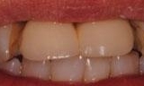 Close up of front teeth before dental bridge in Lincoln