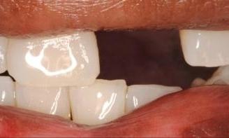 Close up of patient's smile with missing front tooth at dentist in Lincoln