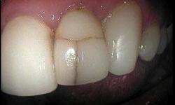 Dental-Crowns-Used-to-Fix-Cracked-Tooth-Before-Image