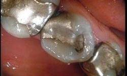Close up of old metal dental fillings at dentist in Lincoln, NE