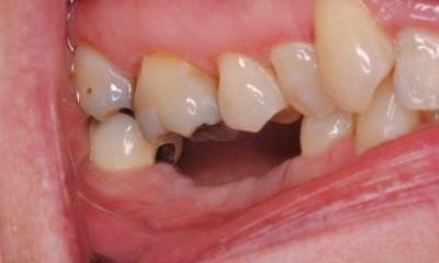 Patient's tooth before dental implant in Lincoln, NE