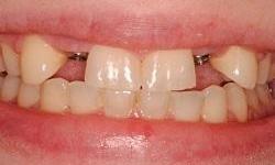 Patient's teeth before dental implants in Lincoln, NE 68506