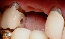 Dental-Implants-Before-Image