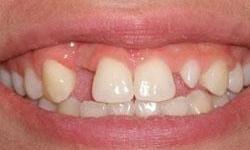 Close up of patient's teeth before smile makeover in Lincoln, NE