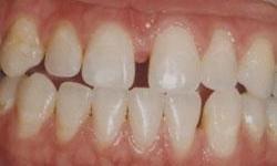 gap in front teeth 