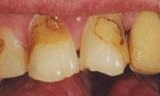 Close up of decayed teeth at cosmetic dentist in Lincoln 68505